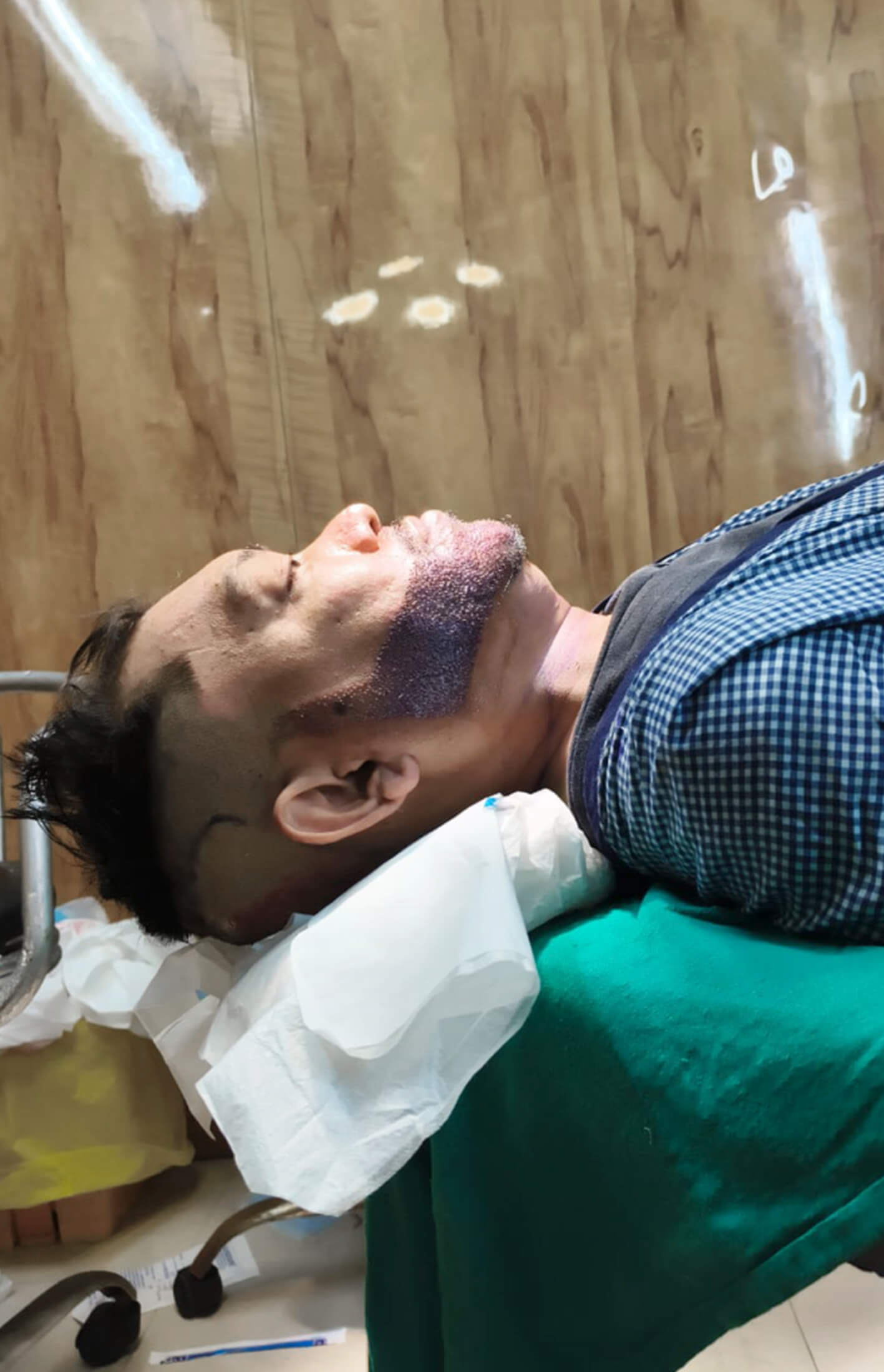 Beard transplant before after